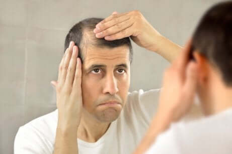 Minoxidil bei Haarausfall: Mann entdeckt Geheimratsecken