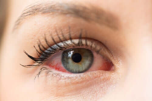 Herpeskeratitis