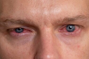 Herpeskeratitis: Was ist das?
