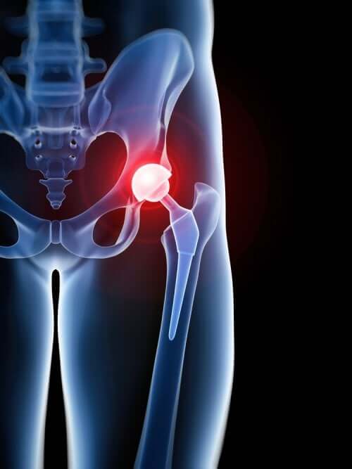Bursitis trochanterica