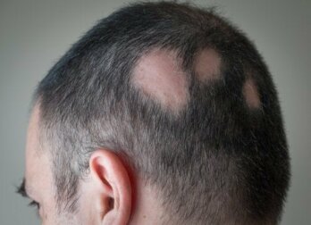 Alopecia areata: Ursachen und Behandlungsmöglichkeiten von kreisrundem Haarausfall