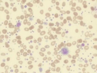 Thrombozytose: Symptome, Ursachen und Behandlung