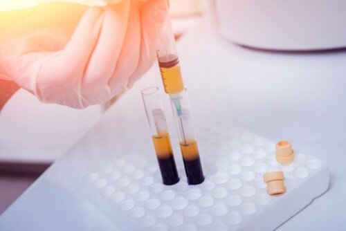 Welche Arten von Thrombozytose gibt es?
