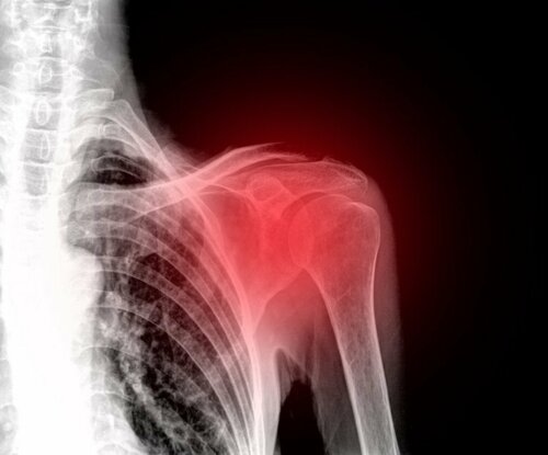 Frozen Shoulder