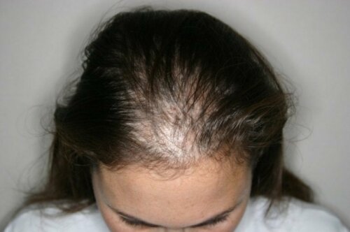 Alopecia areata