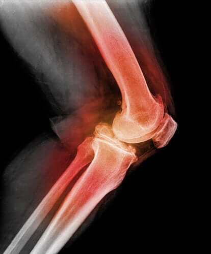 Luxation der Kniescheibe: Welche Ursachen können dazu führen?