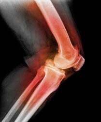 Luxation der Kniescheibe