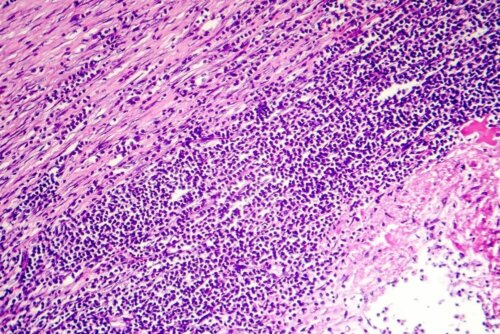 Herzbeutelentzündung: verschiedene Arten