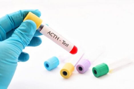 Röhrchen mit Blutprobe zur ACTH-Analyse