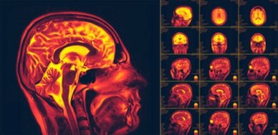 Was bedeutet Neuroplastizität?