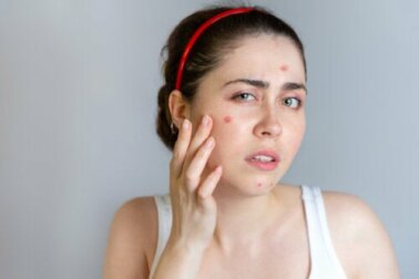 Aknebehandlung: Welche Möglichkeiten gibt es?