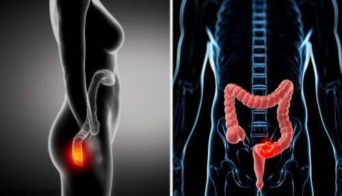 Wann kommt eine Anoskopie zur Anwendung?