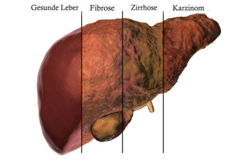 Leberstoffwechsel und Leberkrankheiten