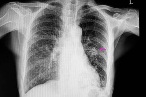 Lungenknoten: Was sollte man darüber wissen?