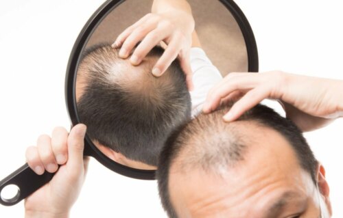 Warum kommt es zu Haarausfall? Androgener Haarausfall
