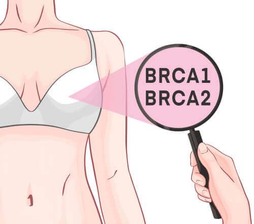 Brustkrebs und die Rolle der Gene BRCA-1 und BRCA-2