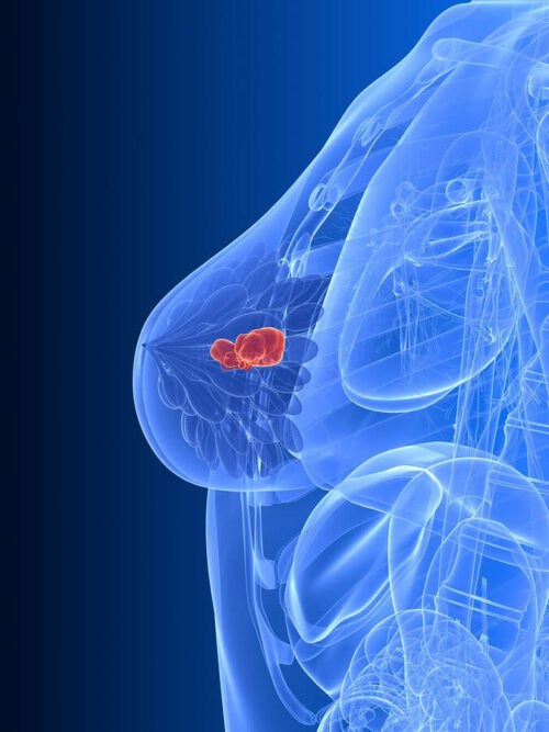 Behandlung eines triple-negativen Mammakarzinoms mit einer Mutation der Gene BRCA-1 und BRCA-2