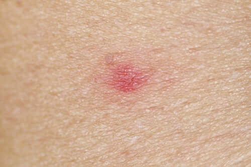 Insektenstich auf Haut