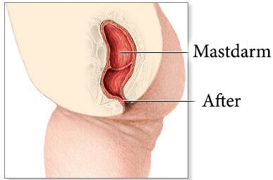 Anoskopie bei Problemem im Bereich des Mastdarms und Afters