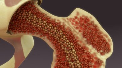 Intraossäre Infusion und Nachsorge