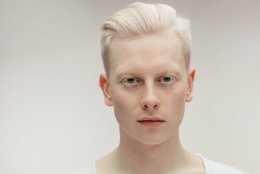 Alles über Menschen mit Albinismus