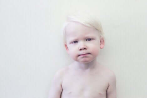 Menschen mit Albinismus: Kleines Kind