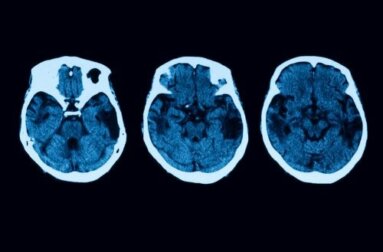 Posteriore kortikale Atrophie: Diagnose und Behandlung