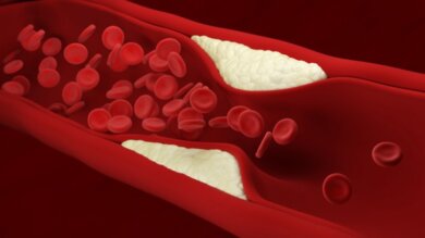 Arterienverkalkung (Arteriosklerose): Symptome und Behandlung