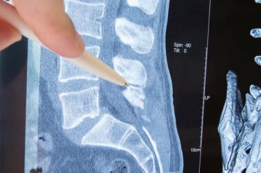 Radikulopathie: Ursachen, Symptome und Behandlung