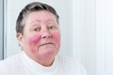 Hauterkrankung Rosazea: Ursachen und Symptome