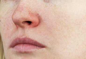 Rote Äderchen im Gesicht: Was ist Couperose?