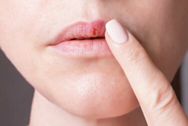 Typen von Herpes: Alles Wissenswerte!