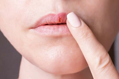 Typen von Herpes: Alles Wissenswerte!