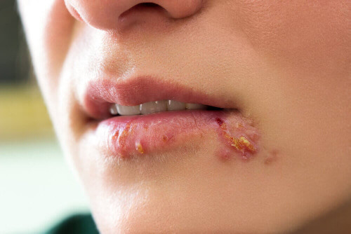 Typen von Herpes: Lippenherpes