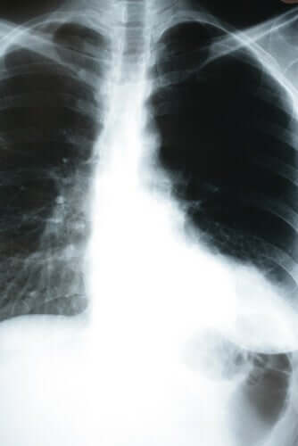 Auswirkungen einer Lungenentzündung auf den Körper