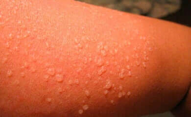 Wie wirkt das neue Coronavirus auf die Haut?