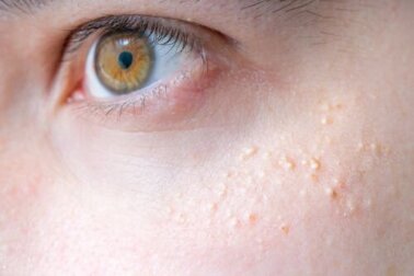 Lichen pilaris: Können Naturheilmittel helfen?