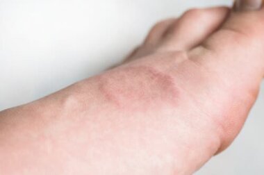 Wissenswertes über die Hauterkrankung Granuloma anulare