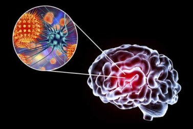 Enzephalitis: Symptome, Ursachen und Behandlung