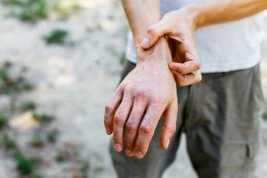 Mann mit Granuloma anulare