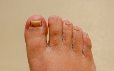 Nagelmykose: Können Hausmittel helfen?