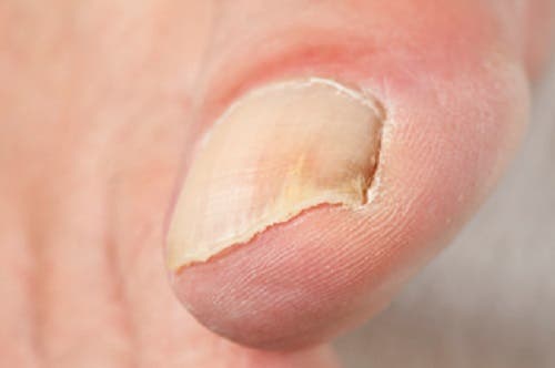 Nagelmykose