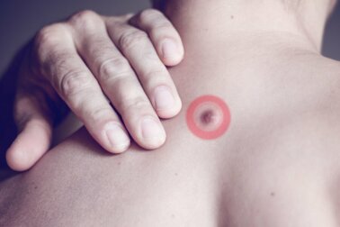 Pickel am Rücken: Wie kommt es dazu?