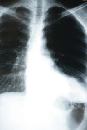 stille Lungenentzündung durch Röntgenbild erkennen