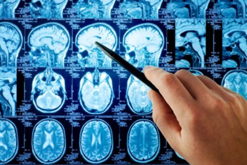 Gehirntumor: Ursachen und Diagnose