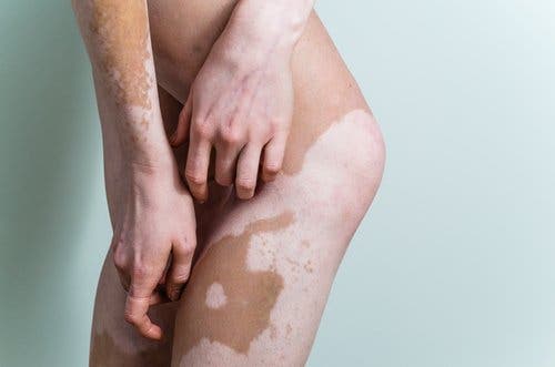 Korrigierendes Make-up als Hilfe bei Vitiligo
