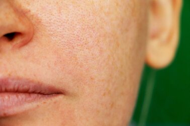 Melasma: 3 Hausmittel gegen Pigmentflecken