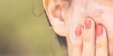 Pigmentstörungen: 5 alternative Behandlungsmöglichkeiten