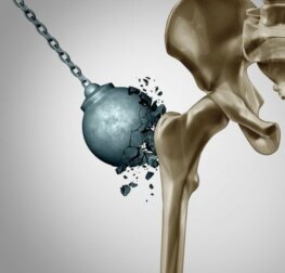Postmenopausale Osteoporose: wichtige Maßnahmen