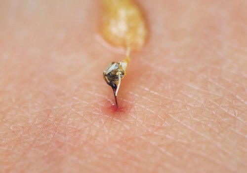 Bienenstiche richtig behandeln